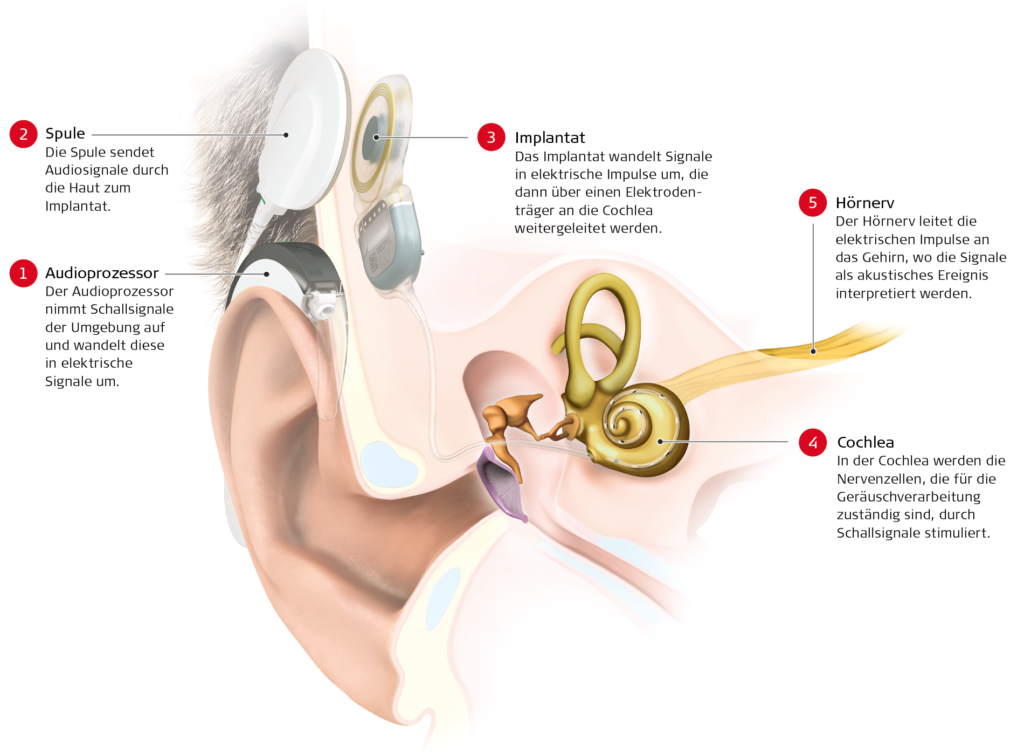 Med El Wie-funktioniert-ein-CI-System MedEl